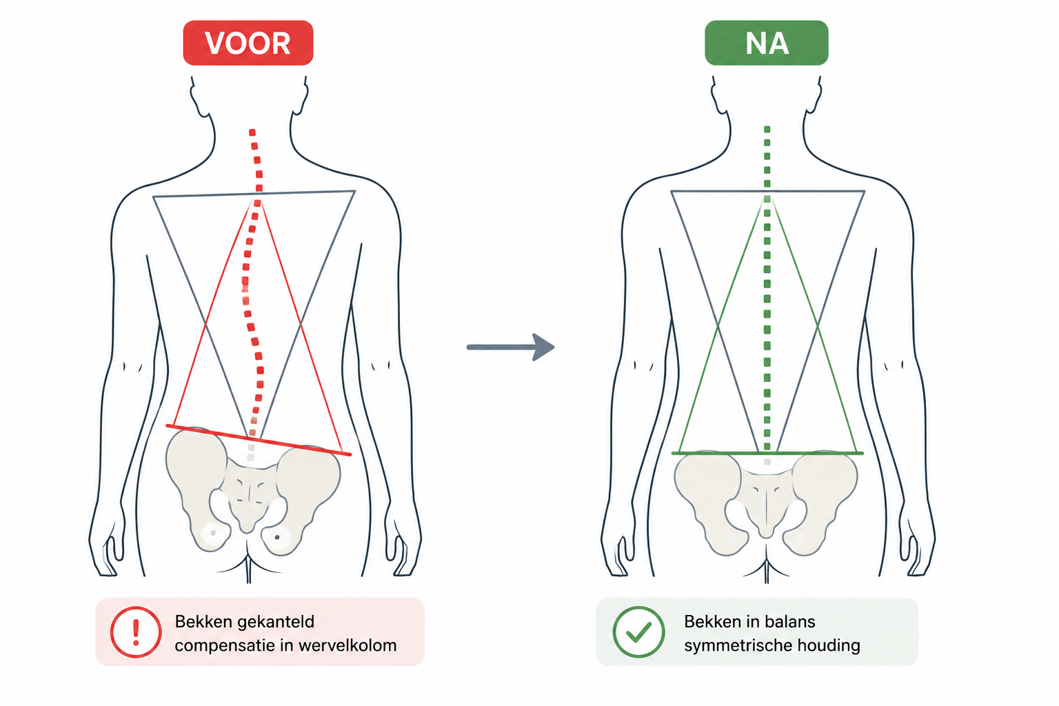 Vergelijking voor en na behandeling: bekkenscheefstand met compensatie in de wervelkolom links, in balans met symmetrische houding rechts